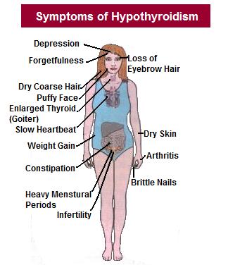 symptoms-of-hypothyroidism